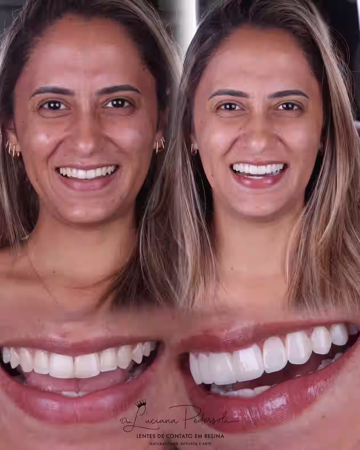 Resultado de lentes de contato em resina, caso 2, Dra. Luciana Pedersoli