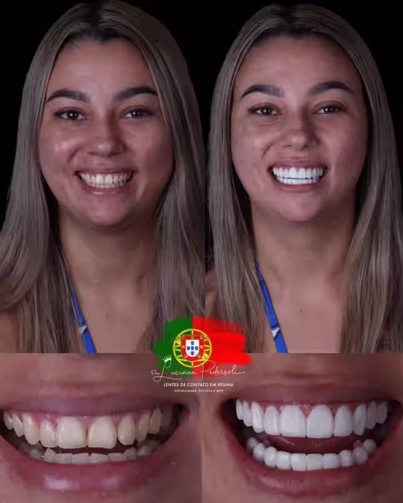 Resultado de lentes de contato em resina, caso 4, Dra. Luciana Pedersoli