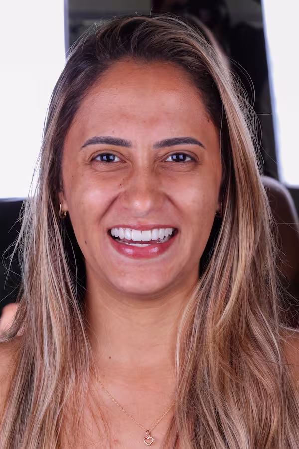 Depois, sorriso natural após lentes de contato em resina, Dra. Luciana Pedersoli